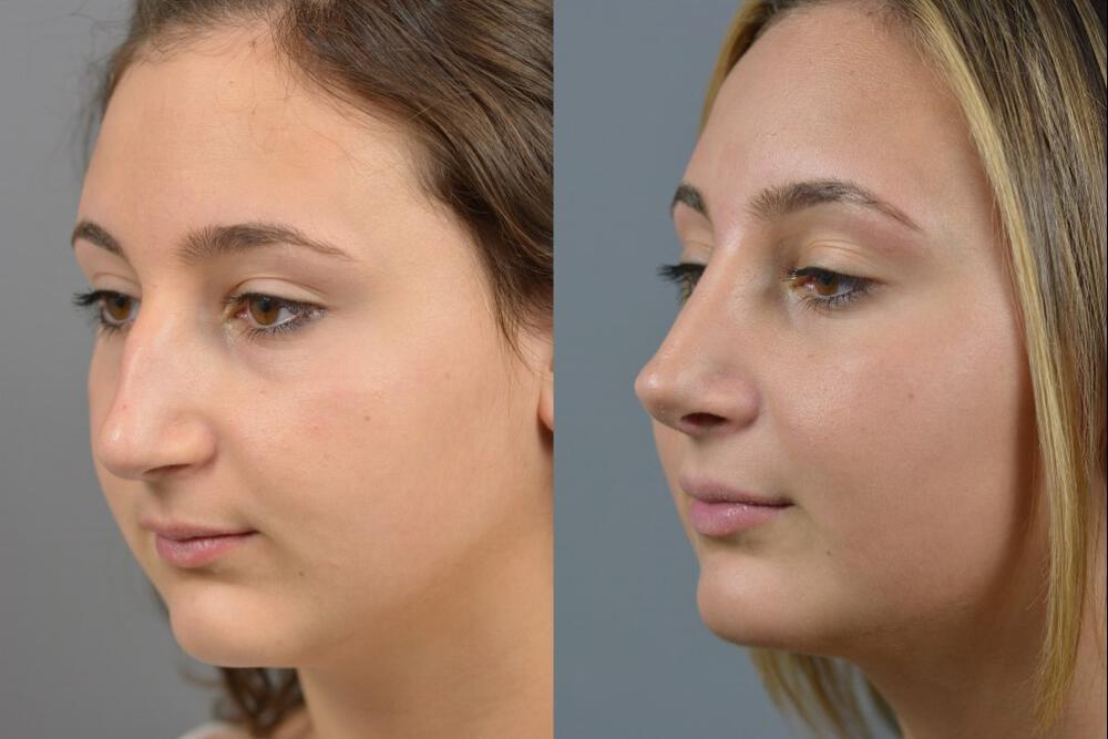 Cosmetic Nose Surgery : Rhinoplasty | Cleveland Clinic
