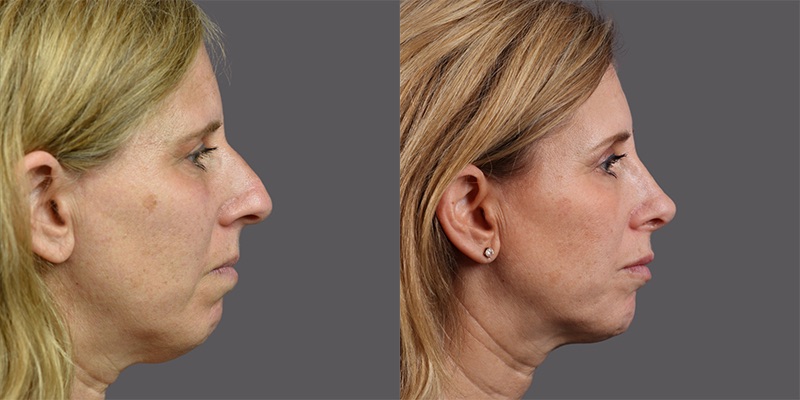 Cosmetic Nose Surgery Transforming Your Profile Forever