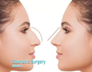 Cosmetic Surgery Mexico Offers Transformative Beauty