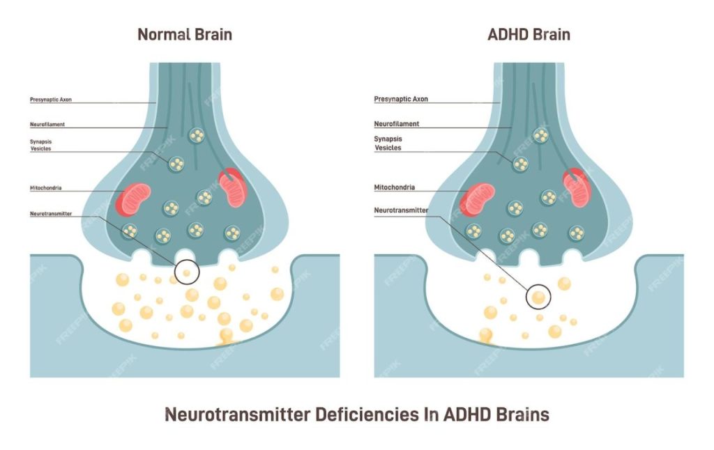 ADHD, What is it? Help Your Child With Treatment from BrainTrainUK ...